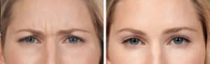 botox before and after photos new york