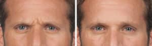 botox wrinkle treatment before and after photos new york