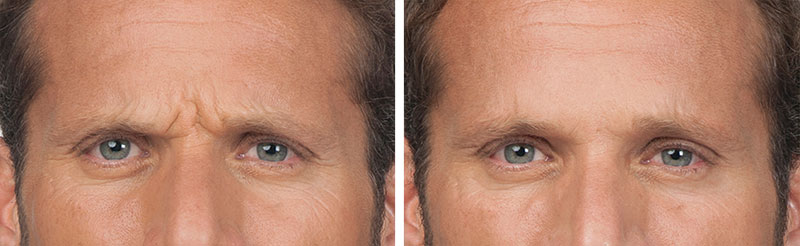 botox before and after photos new york
