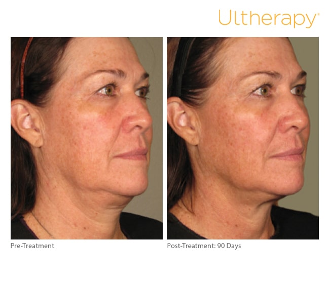 NYC ultherapy treatments