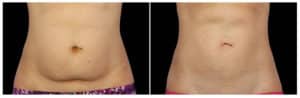 CoolSculpting Before and After Photos