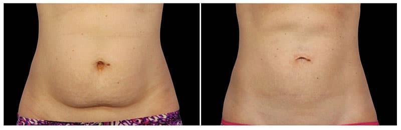 CoolSculpting NYC Before and After Photos