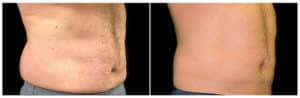 Before and After New York CoolSculpting