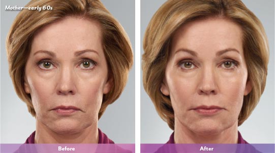 facial fillers new york