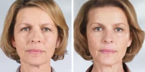 best ny sculptra results