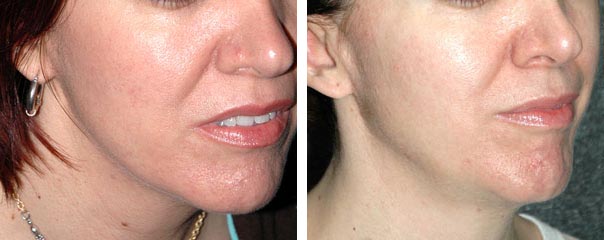 co2 laser resurfacing photos