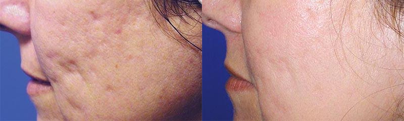 laser skin resurfacing new york