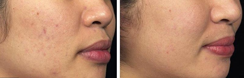 laser skin resurfacing nyc