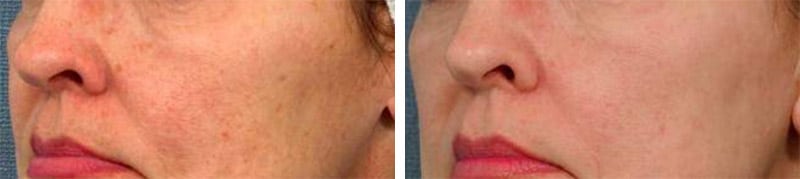 laser peel new york