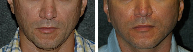 New York acne scar treatment