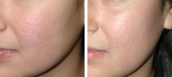 long island co2 laser resurfacing