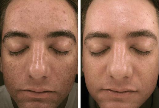 microneedling New York