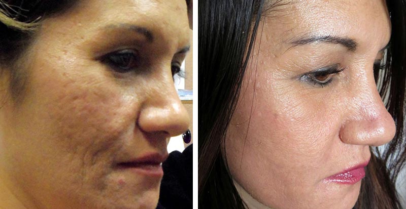 microneedling nyc