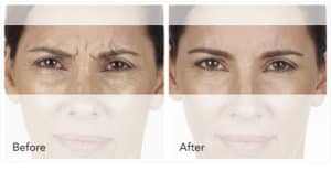 Xeomin Injections for Fine Lines