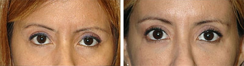 non surgical eyelift new york