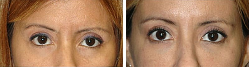 non surgical eyelift new york