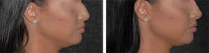 non-surgical rhinoplsaty before and after
