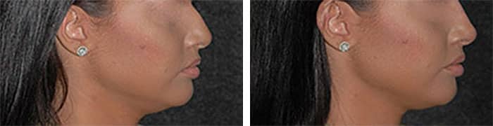 non-surgical rhinoplasty before and after nyc