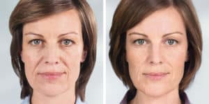 sculptra before and after photos
