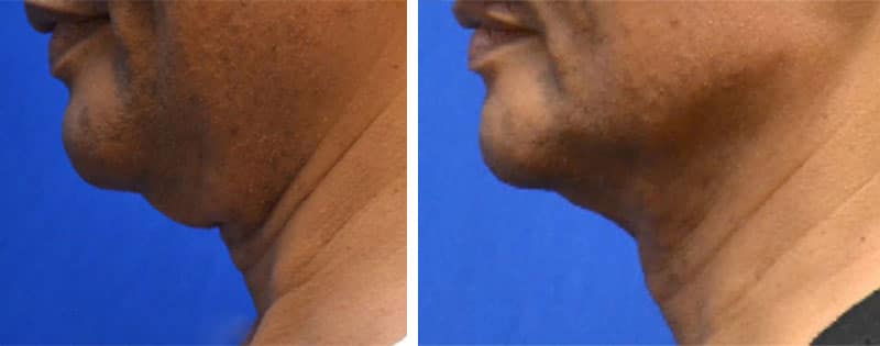 best face neck skin tightening