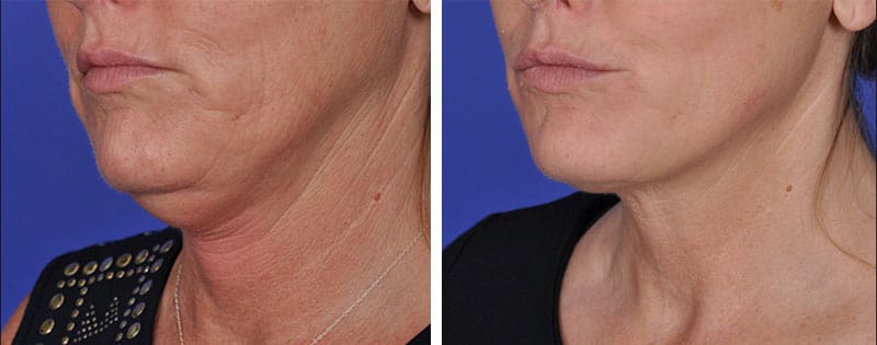 face neck skin tightening new york