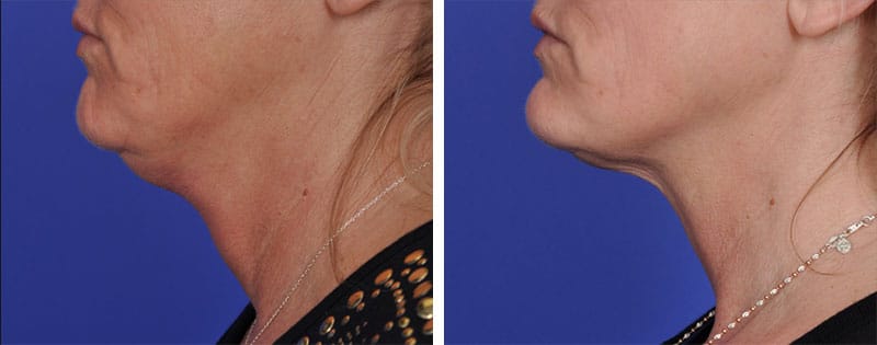 face neck skin tightening nyc