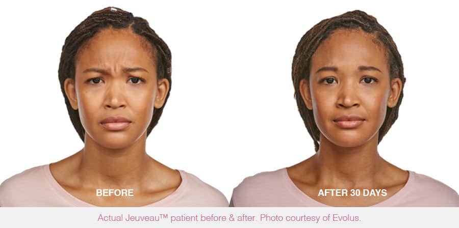 jeuveau before and after results