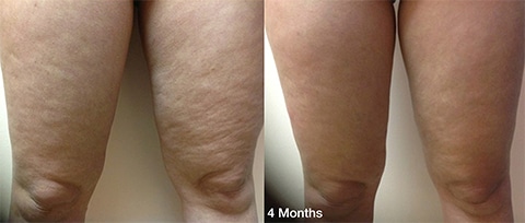 Thermitight Thigh Skin Tightening before and after photos