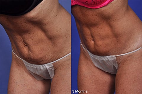 New York Skin Tightening before and after